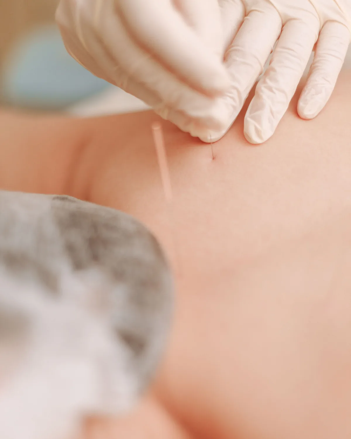 Mão de luva inserindo uma agulha de acupuntura com tubo-guia na parte alta das costas de uma pessoa deitada, perto da nuca.